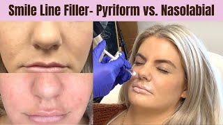 Pyriform vs Nasolabial Filler to Reduce Smile Lines amp Lift Mid Face Under Eyes amp more [upl. by Akcir]