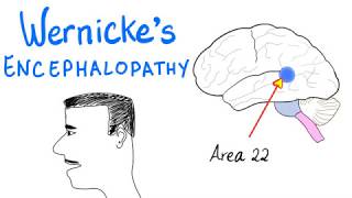 Wernickes Aphasia Fluent Aphasia  Neurology [upl. by Schuyler]