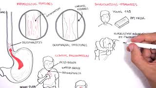 GORD GERD Gastro Oesophageal Reflux Disease  Overview pathophysiology treatment [upl. by Dewayne]