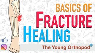 Fracture Healing  ANIMATION  BASICS  The Young Orthopod [upl. by Tinya146]