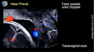 Vasa Previa  ultrasound diagnosis [upl. by Koser597]