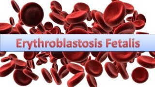 Erythroblastosis fetalisHaemolytic disease of New bornHDN [upl. by Aloeda814]