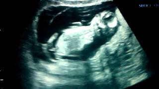 Ultrasound 13 Weeks Boy Confirmed [upl. by Cargian282]