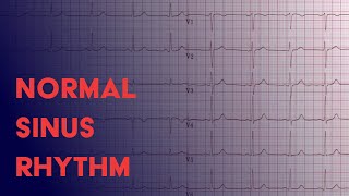 Atrial Fibrillation Afib  EKG ECG Interpretation [upl. by Wickham]