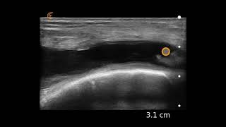 Knee Effusion Ultrasound Image Interpretation [upl. by Weingartner]