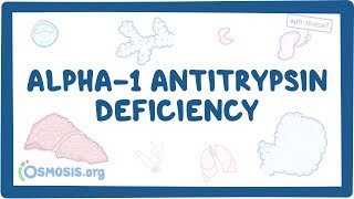 Alpha1 Antitrypsin Deficiency  causes symptoms diagnosis treatment pathology [upl. by Nolrak932]