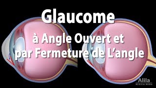 Pathologie du Glaucome Animation [upl. by Nmutua]