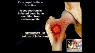 Osteomyelitis Treatment Options [upl. by Aehtna]