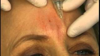 Dr Elliott Shows How to Fill Frown Glabella Lines With A Dermal Filler [upl. by Octavian]