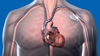 What Is a Pacemaker and How Does It Work [upl. by Chrisse]