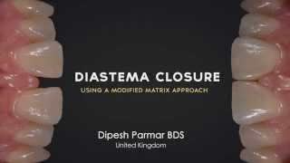 Diastema Closure Perfection  Using a modified matrix approach [upl. by Vin]