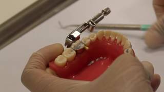 Class II amalgam cavity preparation amp restoration [upl. by Euqinad568]