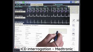 ICD interrogation  Medtronic [upl. by Tolman]