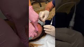 Treating Bulging Forehead Veins [upl. by Cordeelia]