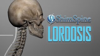 Lordosis [upl. by Stetson98]