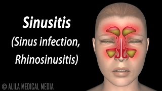 Fungal Sinusitis [upl. by Bouzoun]