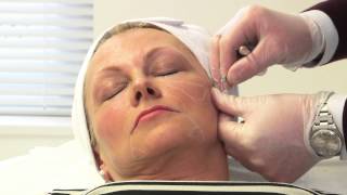 Facial rejuvenation with dermal fillers [upl. by Idroj]